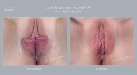 Dr n. med. Łukasz Bełza - Labioplastyka