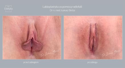 Dr n. med. Łukasz Bełza - Labioplastyka