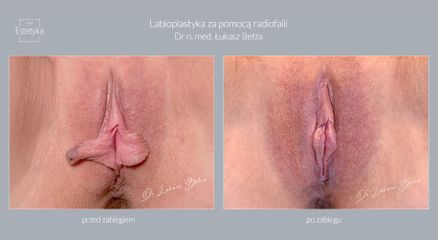 Hoodplastyka z labioplastyką