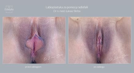 Labioplastyka