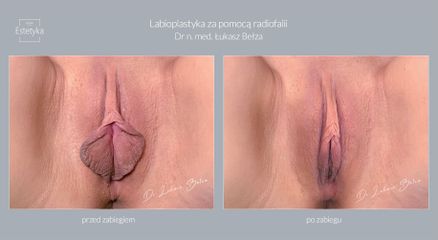 Dr n. med. Łukasz Bełza - Labioplastyka