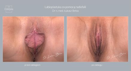 Dr n. med. Łukasz Bełza - Labioplastyka