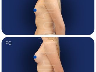 Rekonstrukcja piersi przed i po - 877331