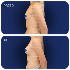 Powiększanie piersi Lek. med. Klaudia Libondi