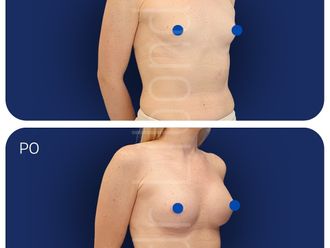 Powiększanie biustu przed i po - 877332