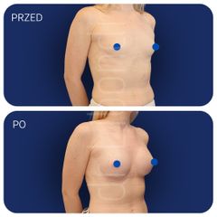 Powiększanie piersi Lek. med. Klaudia Libondi