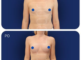 Powiększanie biustu przed i po - 877333