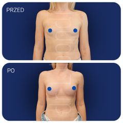 Powiększanie piersi Lek. med. Klaudia Libondi