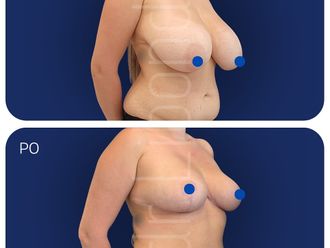 Zmniejszenie biustu przed i po - 877335