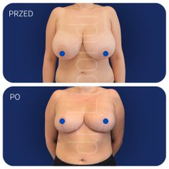 Redukcja piersi - Lek. med. Klaudia Libondi