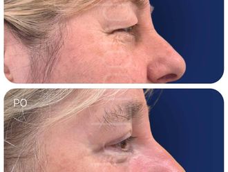 Blefaroplastyka przed i po - 877441