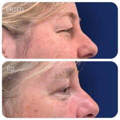 Plastyka powiek górnych - dr Klaudia Libondi