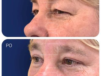Blefaroplastyka przed i po - 877442