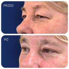 Plastyka powiek górnych - dr Klaudia Libondi