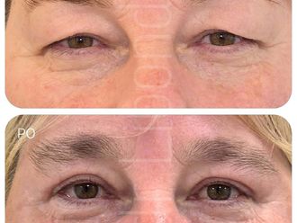 Blefaroplastyka przed i po - 877443