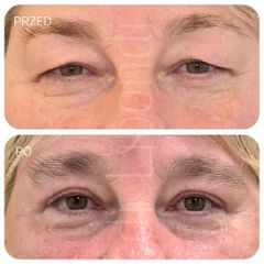 Plastyka powiek górnych - dr Klaudia Libondi