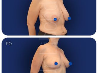 Mastopeksja przed i po - 877547
