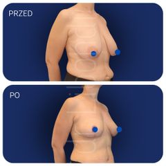 Lifting piersi Lek. med. Klaudia Libondi