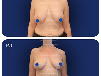 Lipofilling przed i po - 877548