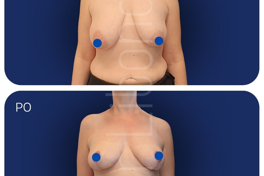 Lipofilling przed i po - 877548