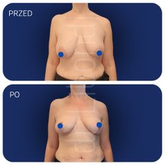 Lifting piersi Lek. med. Klaudia Libondi