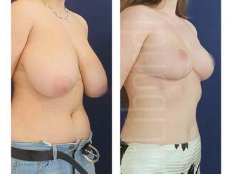 Mastopeksja przed i po - 877579