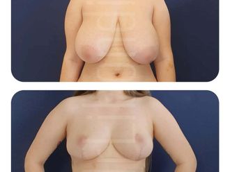 Mastopeksja przed i po - 877580