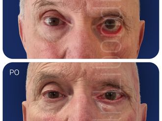 Blefaroplastyka przed i po - 877803