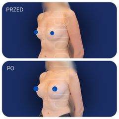 Implanty anatomiczne, powiększanie biustu