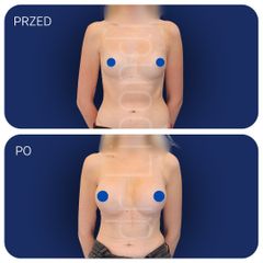 Implanty anatomiczne, powiększanie biustu
