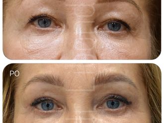 Blefaroplastyka przed i po - 879935