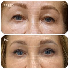 Blefaroplastyka Lek. med. Klaudia Libondi