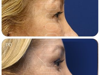 Blefaroplastyka przed i po - 879936