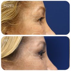 Blefaroplastyka Lek. med. Klaudia Libondi