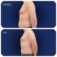 dr Klaudia Libondi - liposukcja oraz obustronne usunięcie gruczołu sutkowego