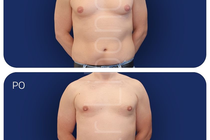 Liposukcja przed i po - 881055
