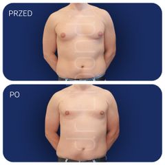 dr Klaudia Libondi - liposukcja oraz obustronne usunięcie gruczołu sutkowego