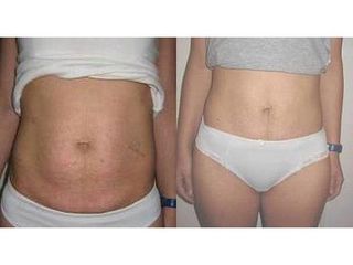 Abdominoplastyka - przed i po