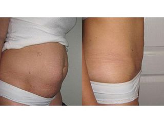 Abdominoplastyka - przed i po
