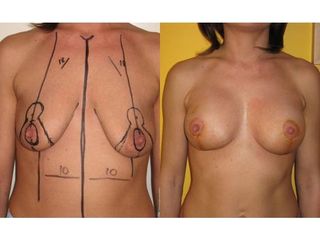 Mastopeksja i powiększenie implantami - przed i po