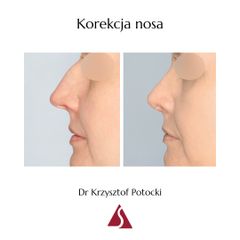 Korekta nosa - Lek. med. Krzysztof Potocki