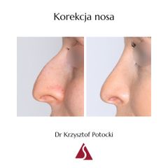 Korekta nosa - Lek. med. Krzysztof Potocki
