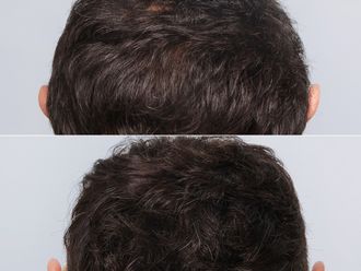 Przeszczep włosów - 868565