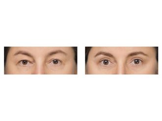 Blefaroplastyka przed i po - 876044