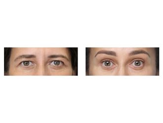 Blefaroplastyka przed i po - 876045