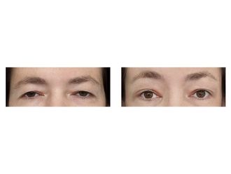 Blefaroplastyka przed i po - 876046