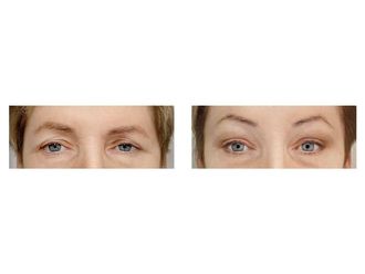 Blefaroplastyka przed i po - 876047