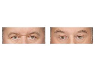 Blefaroplastyka przed i po - 876048