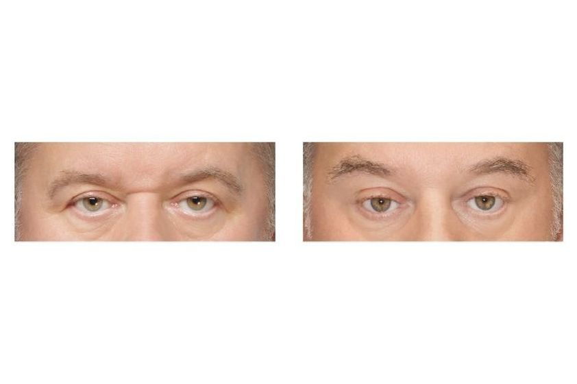 Blefaroplastyka przed i po - 876048