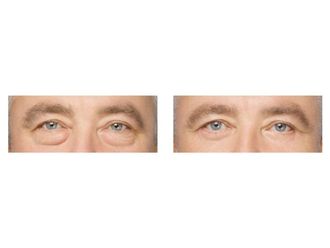 Blefaroplastyka przed i po - 876049